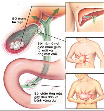 Phát hiện và điều trị sớm bệnh sỏi mật