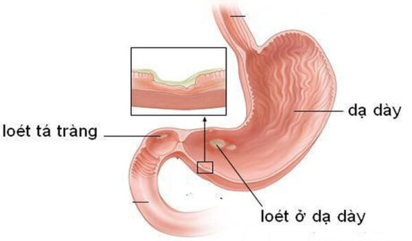 Tìm hiểu về bệnh viêm loét dạ dày – Tá tràng