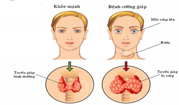 Bệnh cường giáp và các biến chứng tim mạch