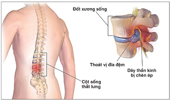 Sai lầm phổ biến có thể gây bại liệt, tàn phế suốt đời