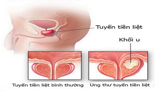 Ai dễ bị ung thư tuyến tiền liệt?