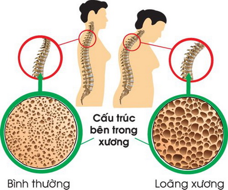 Làm gì để tránh loãng xương?