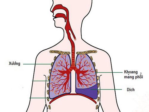 Biến chứng nguy hiểm của bệnh lao phổi