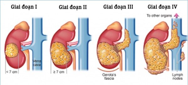 Mách bạn nhận biết sớm ung thư thận
