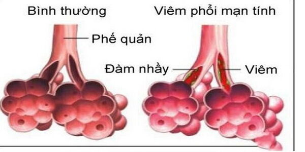 Phòng bệnh viêm phổi ở người lớn