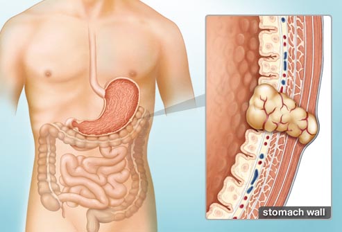 Thuốc mới trị khối u mô đệm đường tiêu hóa tiến triển