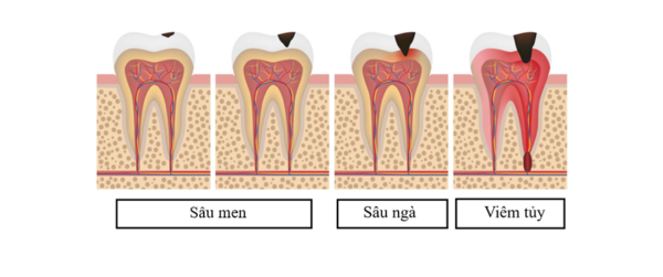 Toàn cảnh về bệnh sâu răng và biện pháp đề phòng