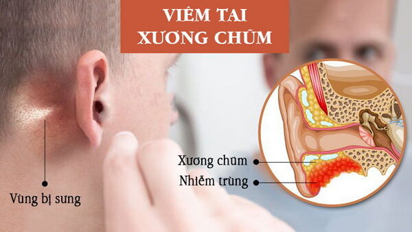 Đối phó với bệnh viêm tai hay gặp ở trẻ nhỏ