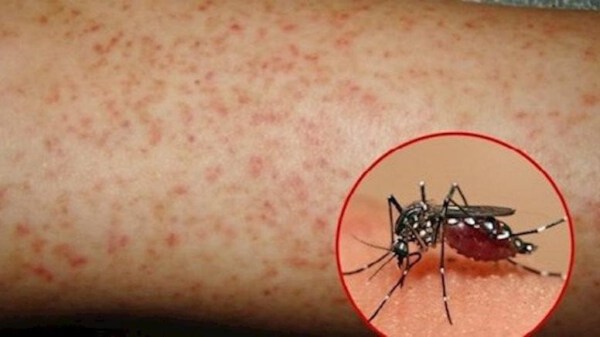 Chú ý với các biến chứng của bệnh sốt xuất huyết (Dengue)