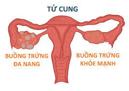 Phụ nữ có hội chứng buồng trứng đa nang cần lưu ý gì?