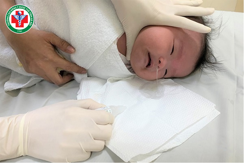 Kỹ thuật hút đờm có thể áp dụng cho trẻ sơ sinh bị sặc bộtKỹ thuật hút đờm có thể áp dụng cho trẻ sơ sinh bị sặc bột