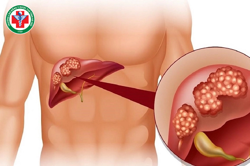 Y học cổ truyền giúp thải độc tố trong gan