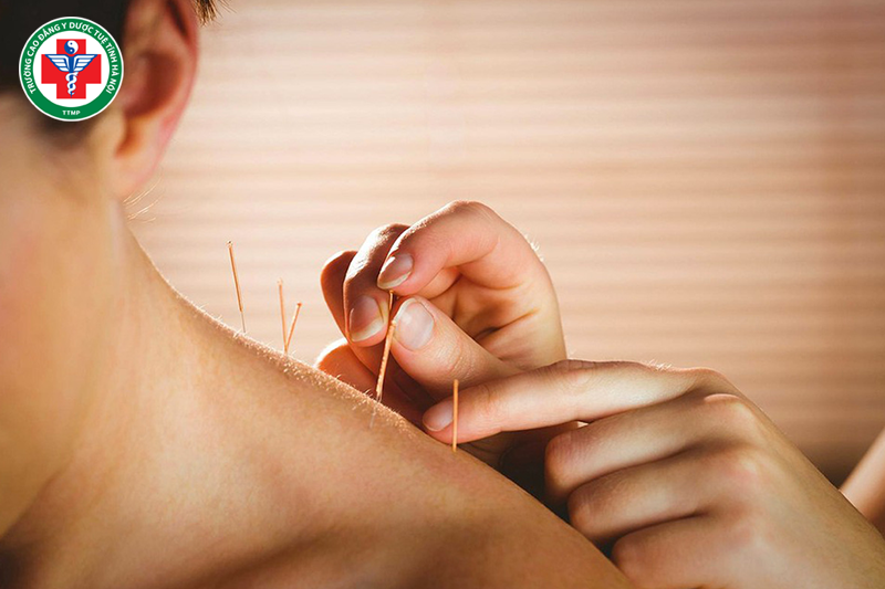 Vật lý trị liệu y học cổ truyền giúp thư giãn thần kinh