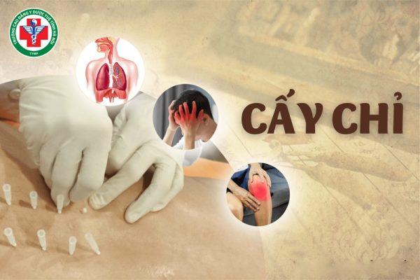 Cấy chỉ trong Y học cổ truyền – Giải pháp điều trị không dùng thuốc hiệu quả