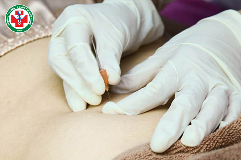 Cấy chỉ giúp điều chỉnh cảm giác thèm ăn, tăng chuyển hóa năng lượng