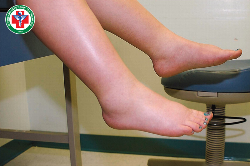 Điều tiết dịch thủy giúp cơ thể tránh tích nước