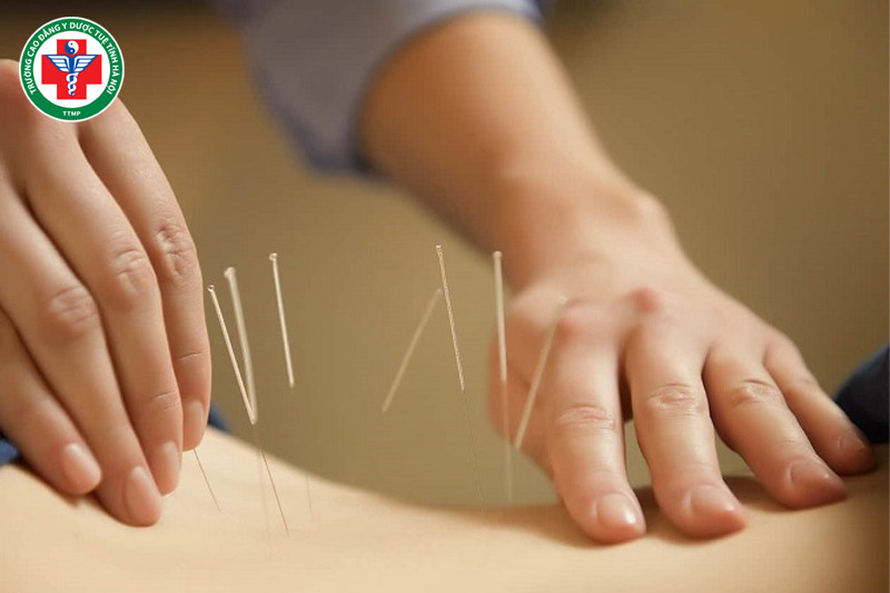 Châm cứu, xoa bóp bấm huyệt vùng Tỳ – Vị