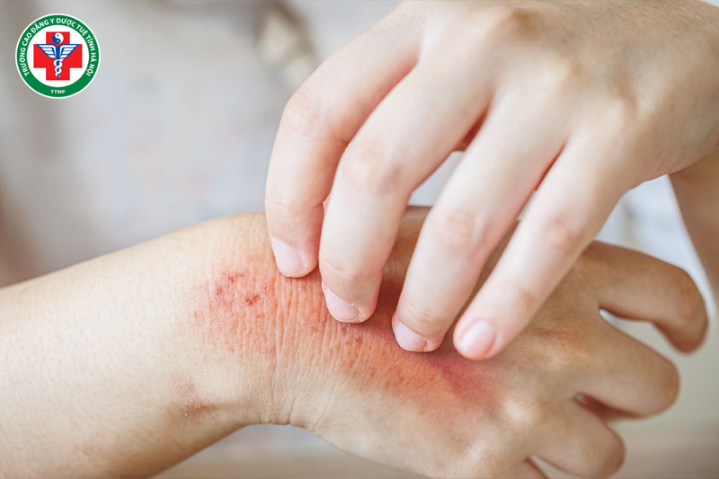 Thể chất đặc biệt dễ bị dị ứng