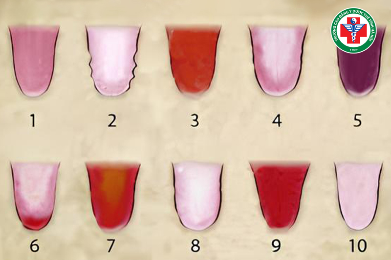 Quan sát lưỡi, hay còn gọi là thiệt chẩn, là nội dung đặc biệt quan trọng trong vọng chẩn.