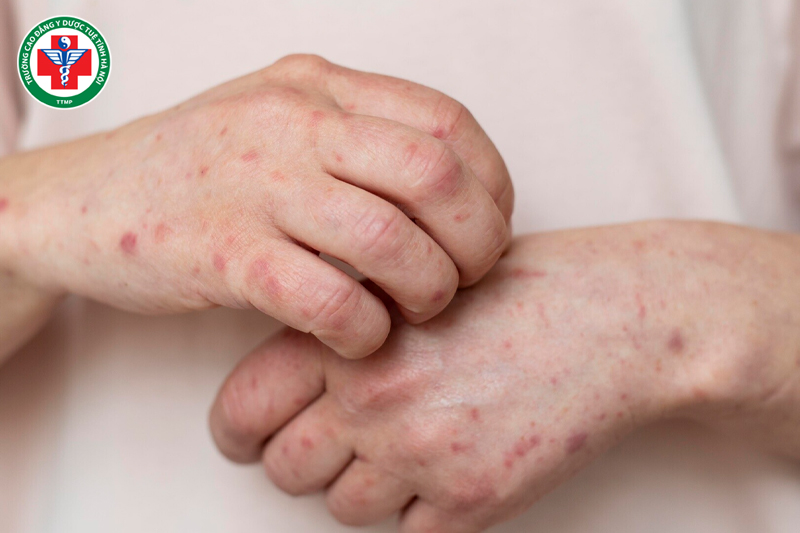 Huyết nhiệt có thể gây xuất huyết hoặc phát ban.