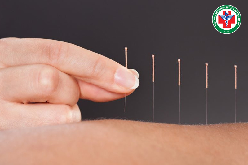 Tác động huyệt đạo cần tuân thủ nguyên tắc an toàn, đúng kỹ thuật