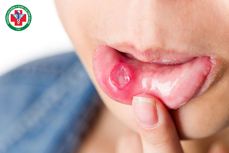 Thanh pháp trong điều trị rối loạn chức năng do nhiệt