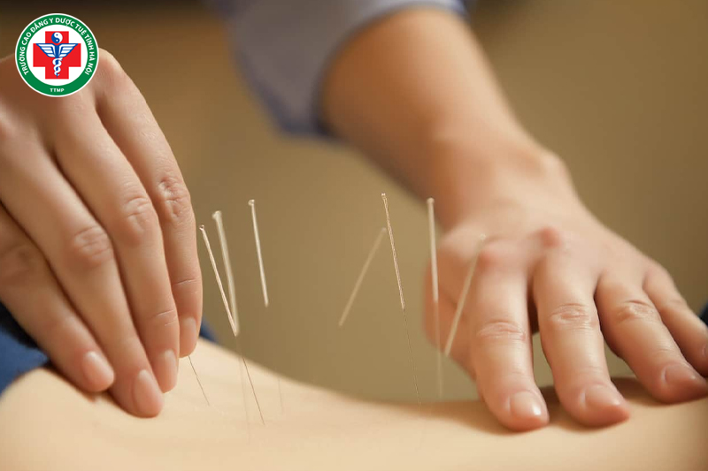 Châm cứu và bấm huyệt giúp điều hòa khí huyết và cải thiện chức năng tạng phủ