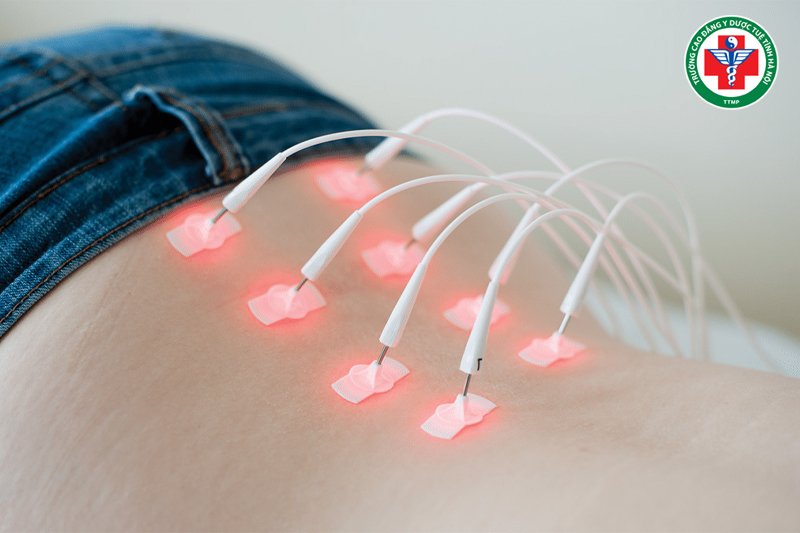 Laser châm là gì? Nguyên lý, công dụng và ứng dụng trong điều trị hiện đại