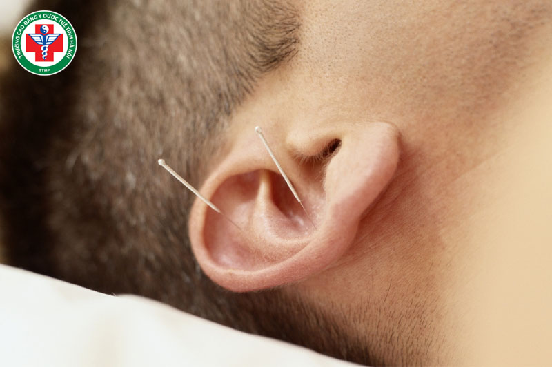 Nhĩ châm là gì? Tác dụng và ứng dụng điều trị Đông y