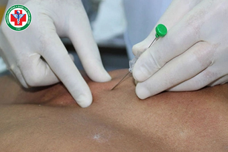 Thủy châm là phương pháp xâm lấn có thể gây đau