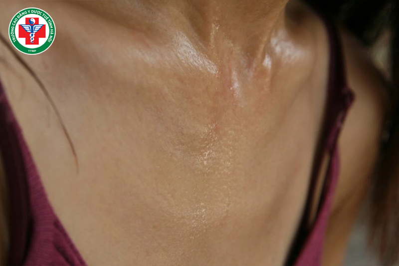 Vệ khí giúp kiểm soát mồ hôi