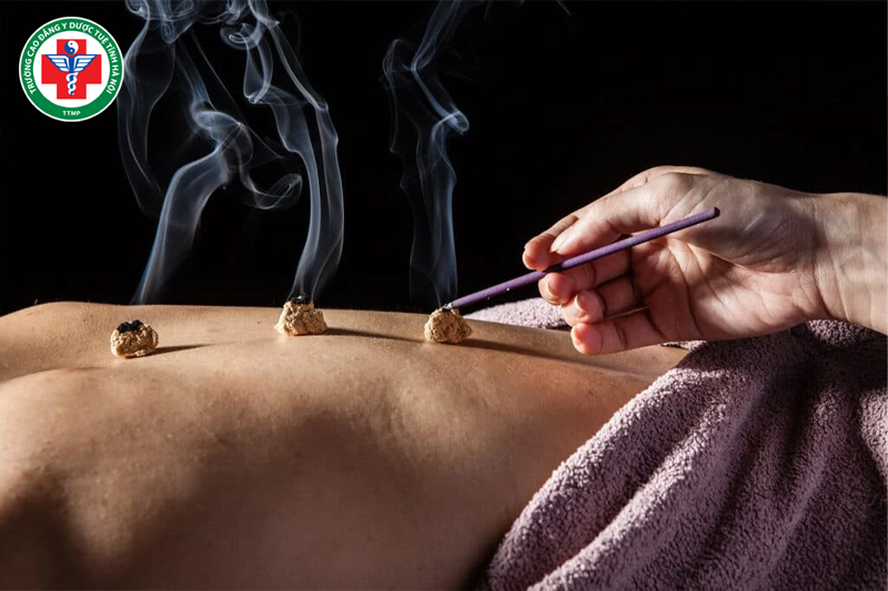 Cứu ngải để làm ấm huyệt 