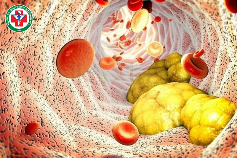 Nhiệt chứng do rối loạn chuyển hóa gây ra mạch sác