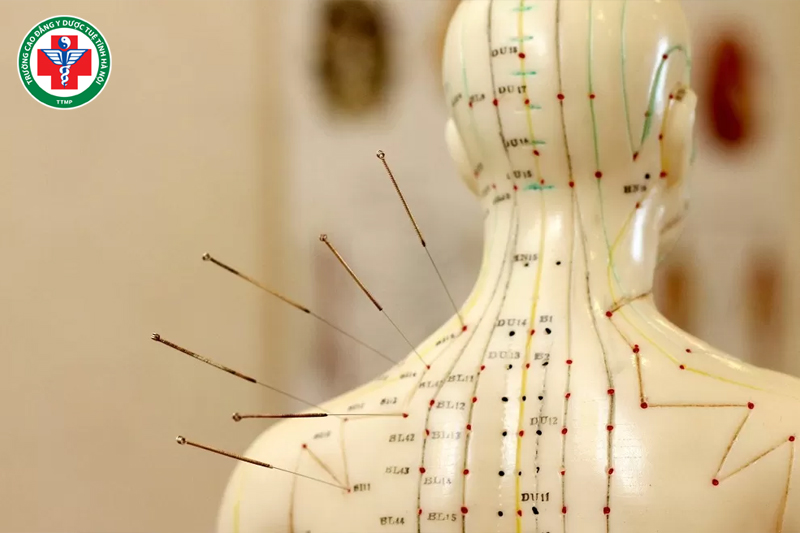 Châm cứu hỗ trợ điều hòa chức năng tạng phủ