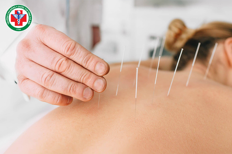 Châm cứu: giúp điều hòa khí huyết và khai thông kinh lạc