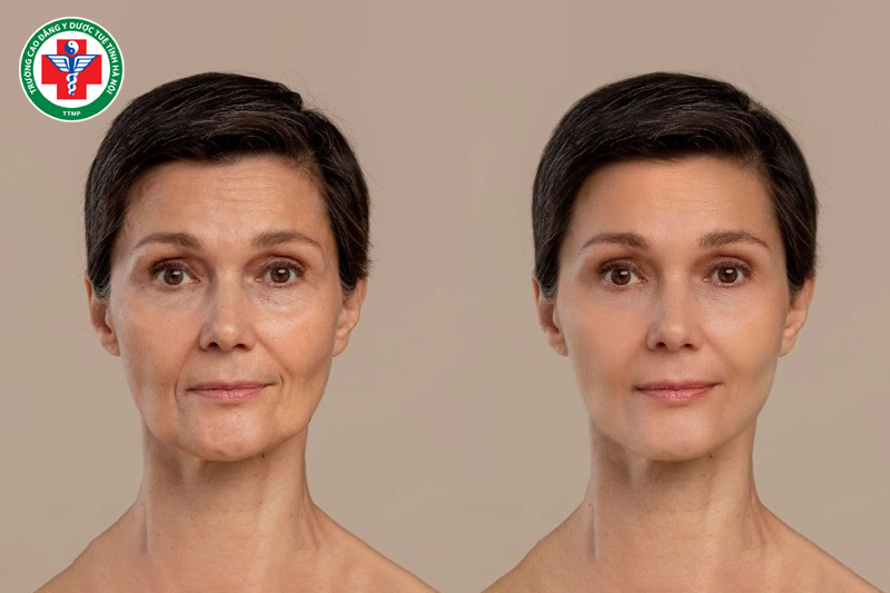 Mai hoa châm hỗ trợ làm chậm quá trình lão hóa