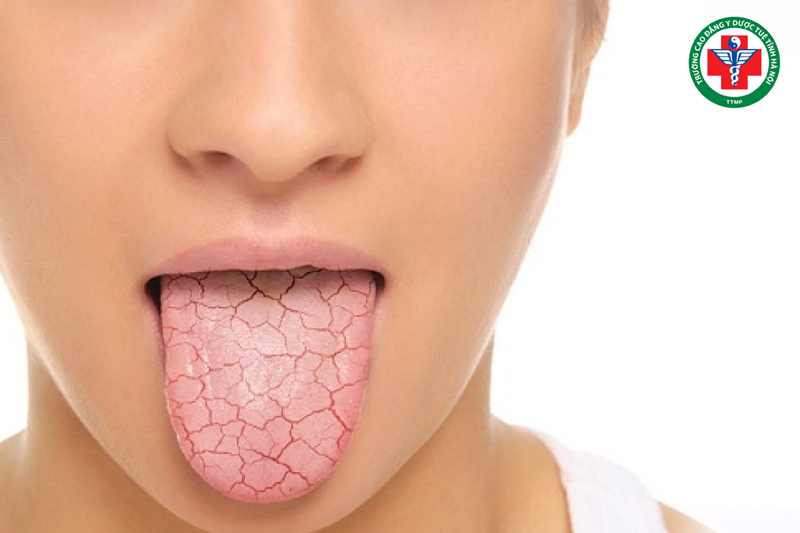 Người bệnh thường cảm thấy khô miệng, khô họng hoặc khô da kéo dài