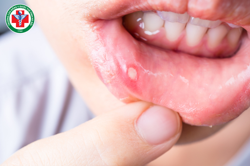 Hỏa tà gây nhiệt miệng tái phát nhiều lần