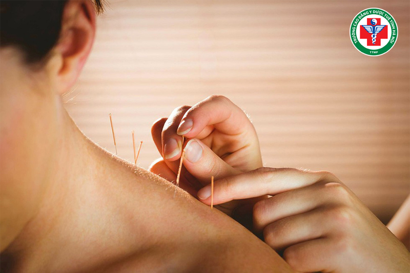 Châm cứu giúp kích thích các huyệt đạo liên quan đến tạng Tâm