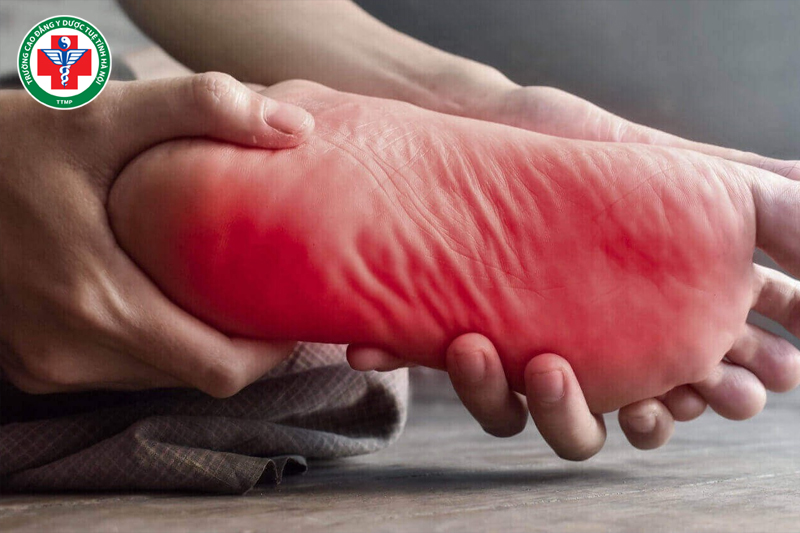 Nóng ở lòng bàn tay, lòng bàn chân là biểu hiện thường gặp ở chứng âm hư